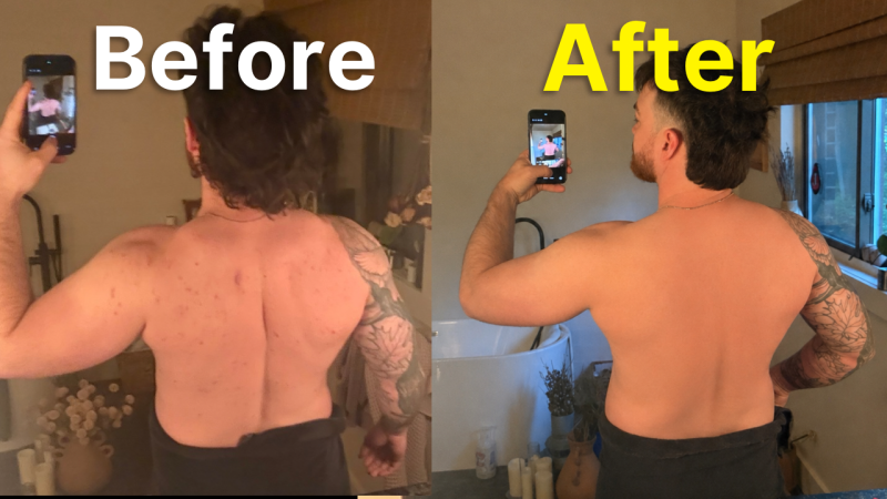 Split-screen: left shows a shirtless man’s back with red blemishes and scarring; right shows smoother skin with fewer marks. Tattooed arm visible.Only context: bathroom setting.','Before: back covered in red blemishes and scarring; After: back appears smoother with fewer marks, tattooed arm visible.','Two-panel image of a man’s back in a bathroom: more blemishes on the left, clearer skin on the right.','Informational: back skin condition improving from numerous red spots to smoother skin after treatment.','Left panel labeled Before shows back skin with many red spots; right panel labeled After shows a clearer back.